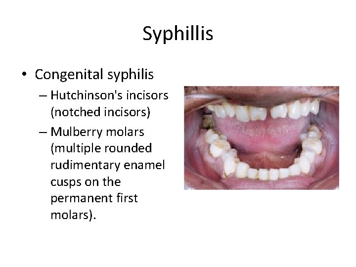 Syphillis • Congenital syphilis – Hutchinson's incisors (notched incisors) – Mulberry molars (multiple rounded