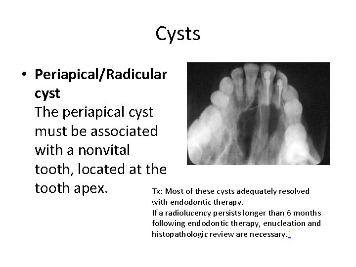 Cysts • Periapical/Radicular cyst The periapical cyst must be associated with a nonvital tooth,