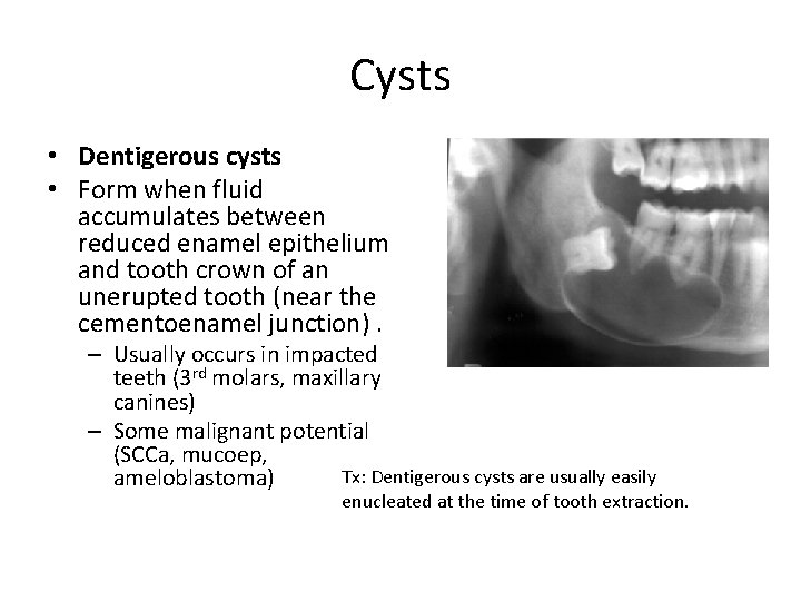 Cysts • Dentigerous cysts • Form when fluid accumulates between reduced enamel epithelium and