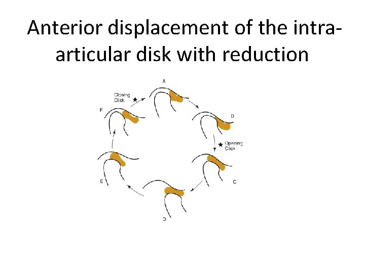  Anterior displacement of the intraarticular disk with reduction 