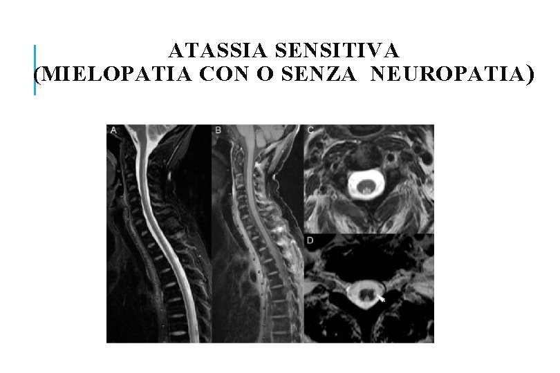 ATASSIA SENSITIVA (MIELOPATIA CON O SENZA NEUROPATIA ) 