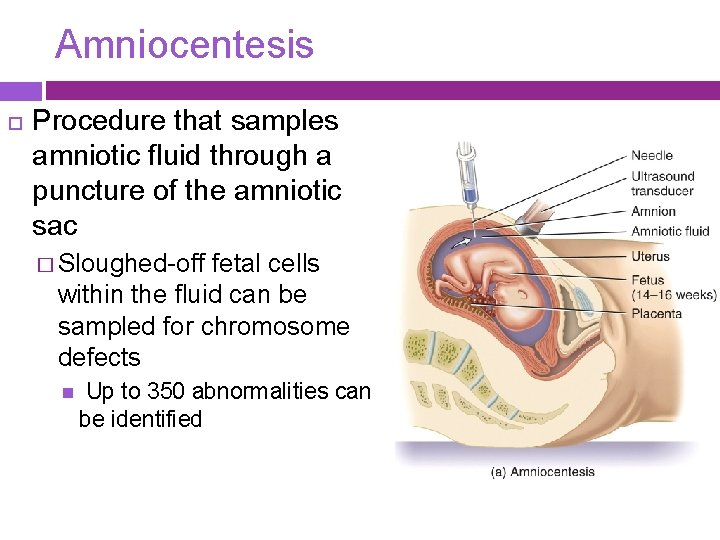 Amniocentesis Procedure that samples amniotic fluid through a puncture of the amniotic sac �
