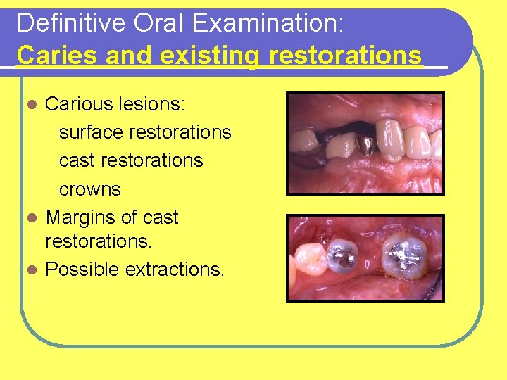Definitive Oral Examination: Caries and existing restorations Carious lesions: surface restorations cast restorations crowns