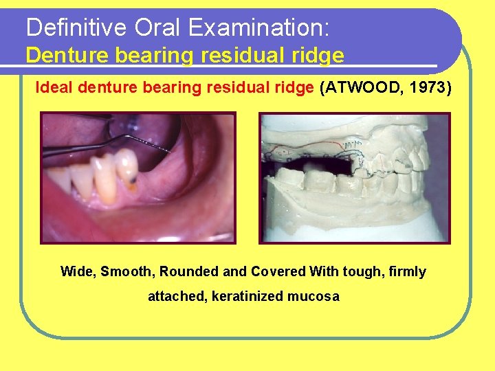 Definitive Oral Examination: Denture bearing residual ridge Ideal denture bearing residual ridge (ATWOOD, 1973)