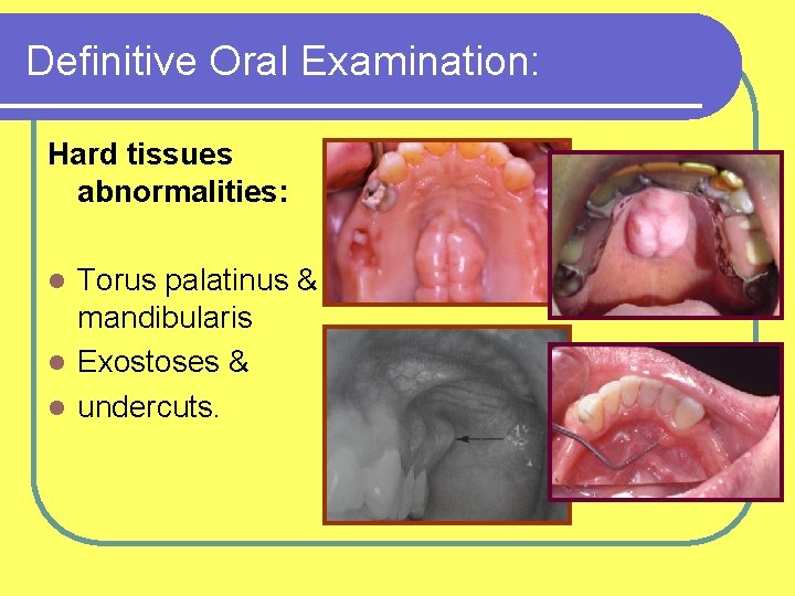 Definitive Oral Examination: Hard tissues abnormalities: Torus palatinus & mandibularis l Exostoses & l