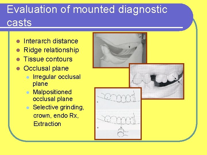 Evaluation of mounted diagnostic casts Interarch distance l Ridge relationship l Tissue contours l