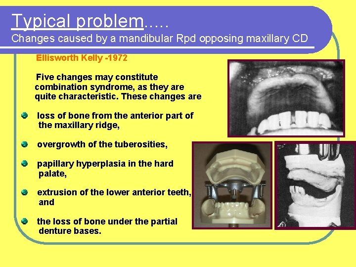 Typical problem. . . Changes caused by a mandibular Rpd opposing maxillary CD Ellisworth