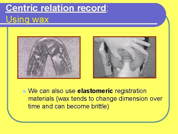 Centric relation record: Using wax l We can also use elastomeric registration materials (wax