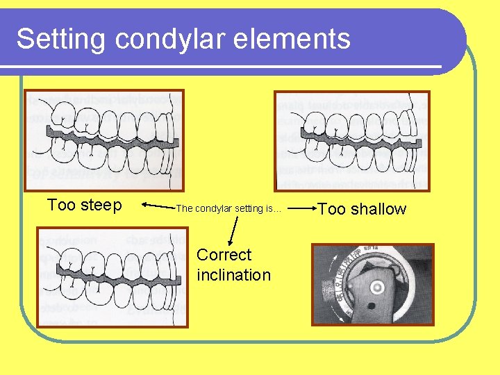 Setting condylar elements Too steep The condylar setting is… Correct inclination Too shallow 
