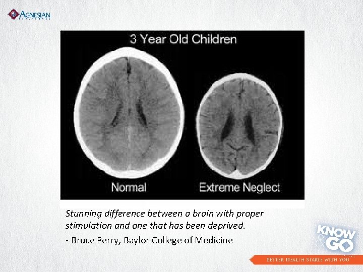 Stunning difference between a brain with proper stimulation and one that has been deprived.