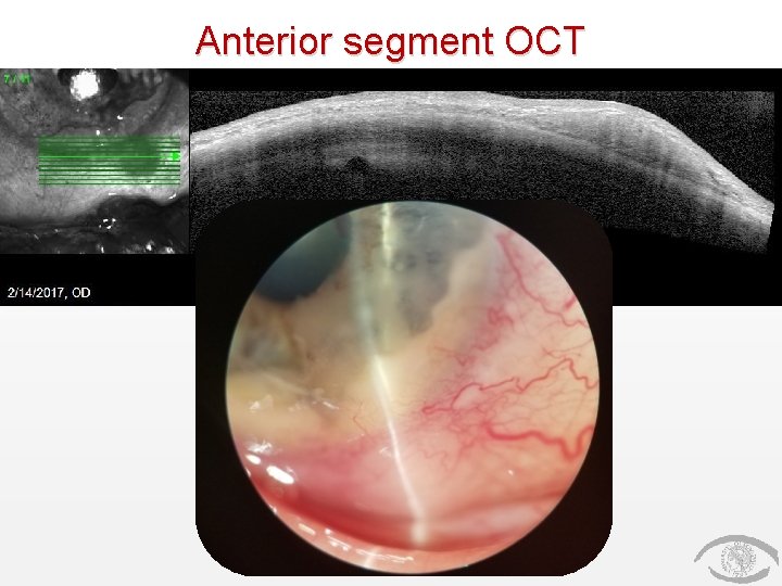 Anterior segment OCT Anterior segment OCT
