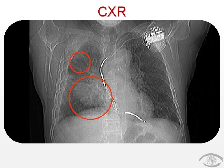 CXR CXR