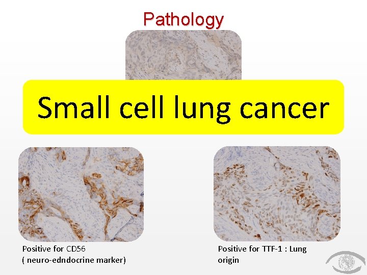 Pathology Small cell lung cancer Negative for Napsin A Positive for CD 56 ( Pathology Small cell lung cancer Negative for Napsin A Positive for CD 56 (