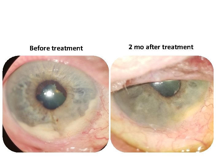 Before treatment 2 mo after treatment Before treatment 2 mo after treatment