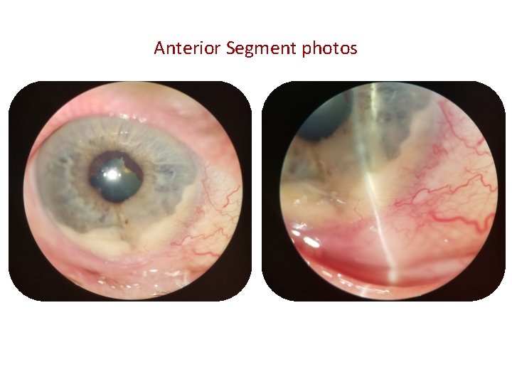 Anterior Segment photos Anterior Segment photos