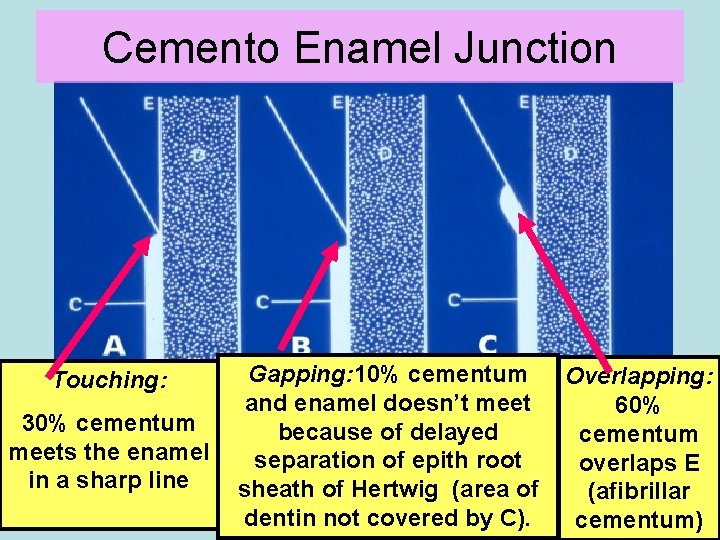 Cemento Enamel Junction Touching: 30% cementum meets the enamel in a sharp line Gapping: