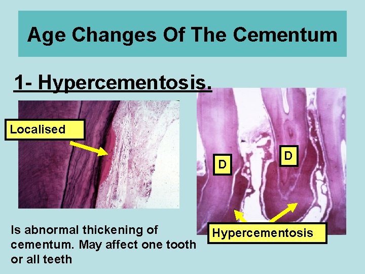 Age Changes Of The Cementum 1 - Hypercementosis. Localised D Is abnormal thickening of