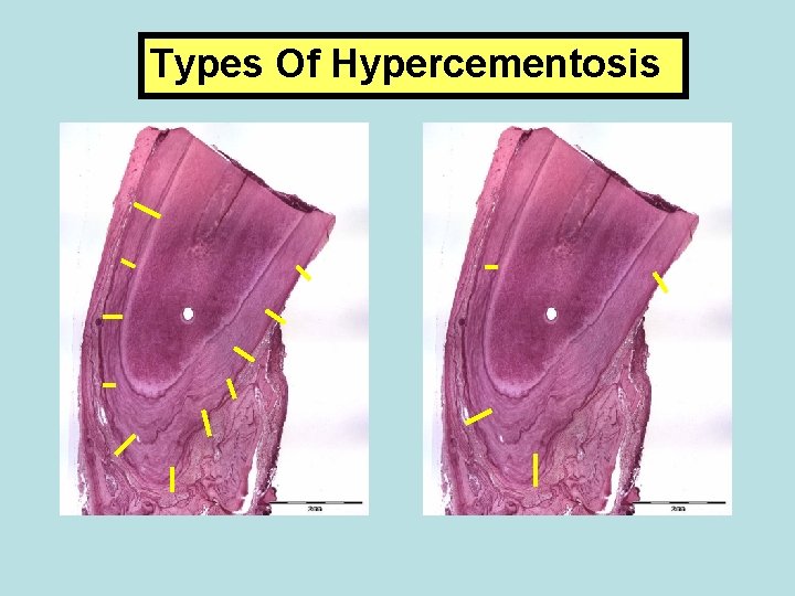 Types Of Hypercementosis 