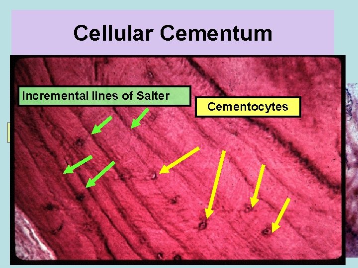 Cellular Cementum Lacunae of cementocytes Incremental lines of Salter Cementocytes PDL side Dentin side