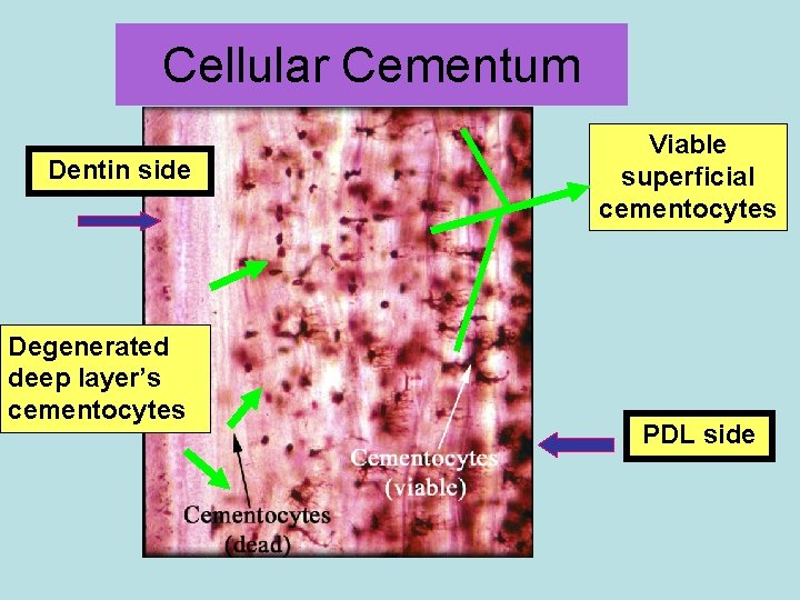 Cellular Cementum Dentin side Degenerated deep layer’s cementocytes Viable superficial cementocytes PDL side 