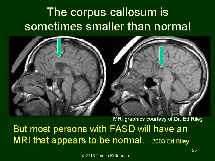 The corpus callosum is sometimes smaller than normal MRI graphics courtesy of Dr. Ed