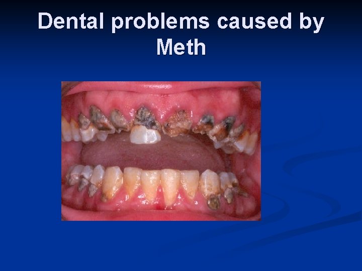 Dental problems caused by Meth 