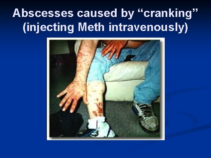Abscesses caused by “cranking” (injecting Meth intravenously) 