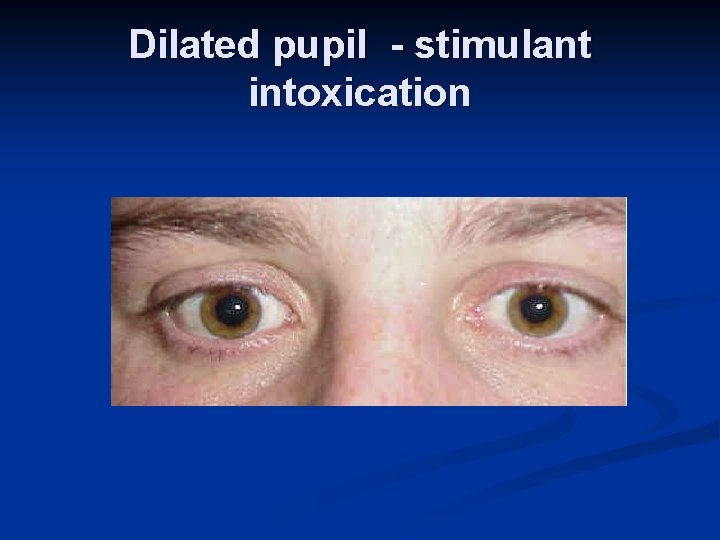 Dilated pupil - stimulant intoxication 