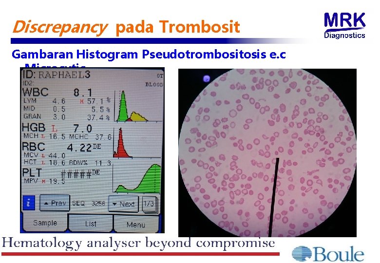 Discrepancy pada Trombosit Gambaran Histogram Pseudotrombositosis e. c Microcytic 