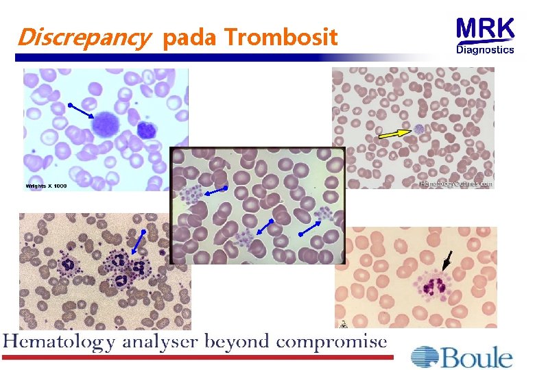 Discrepancy pada Trombosit 