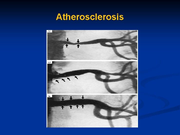 Atherosclerosis 