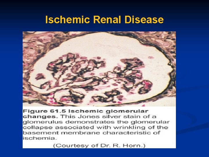 Ischemic Renal Disease 