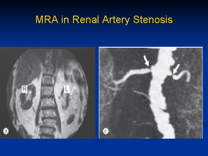 MRA in Renal Artery Stenosis 
