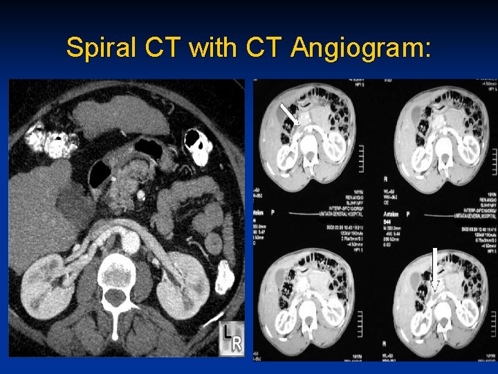 Spiral CT with CT Angiogram: 