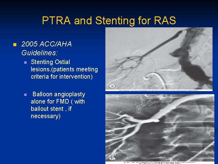 PTRA and Stenting for RAS n 2005 ACC/AHA Guidelines: n Stenting Ostial lesions. (patients