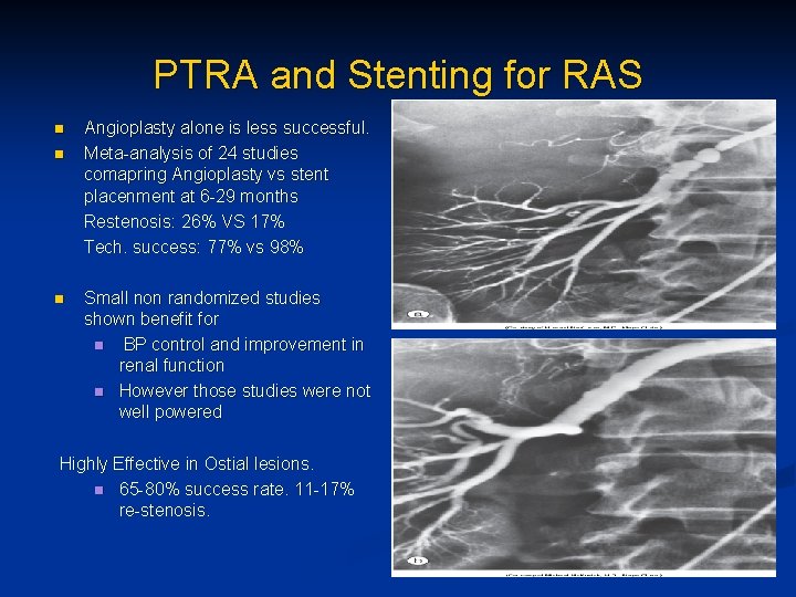 PTRA and Stenting for RAS n n n Angioplasty alone is less successful. Meta-analysis