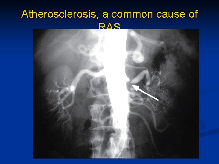Atherosclerosis, a common cause of RAS 