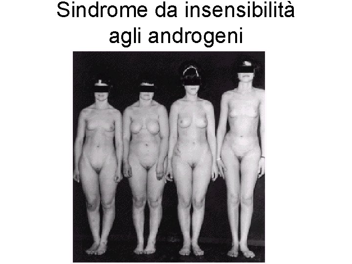 Sindrome da insensibilità agli androgeni 