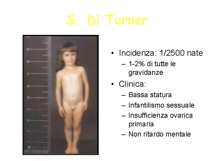 S. Di Turner • Incidenza: 1/2500 nate – 1 -2% di tutte le gravidanze