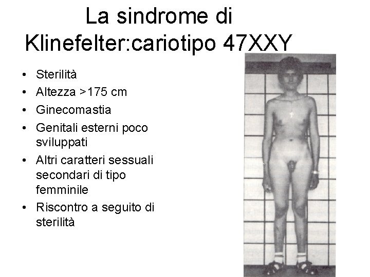 La sindrome di Klinefelter: cariotipo 47 XXY • • Sterilità Altezza >175 cm Ginecomastia