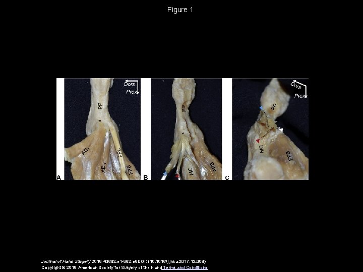 Figure 1 Journal of Hand Surgery 2018 43682. e 1 -682. e 8 DOI: