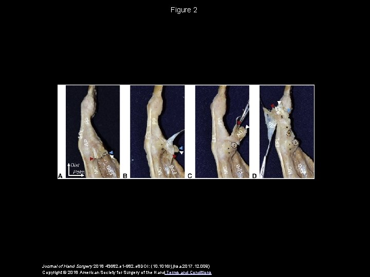 Figure 2 Journal of Hand Surgery 2018 43682. e 1 -682. e 8 DOI: