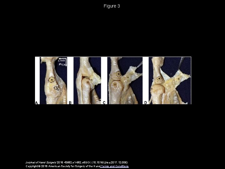 Figure 3 Journal of Hand Surgery 2018 43682. e 1 -682. e 8 DOI: