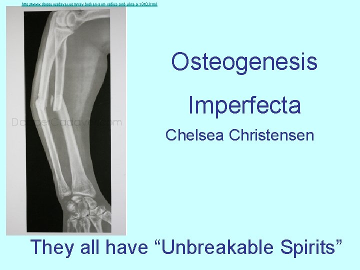 http: //www. dappercadaver. com/ray-broken-arm-radius-and-ulna-p-1310. html Osteogenesis Imperfecta Chelsea Christensen They all have “Unbreakable Spirits”