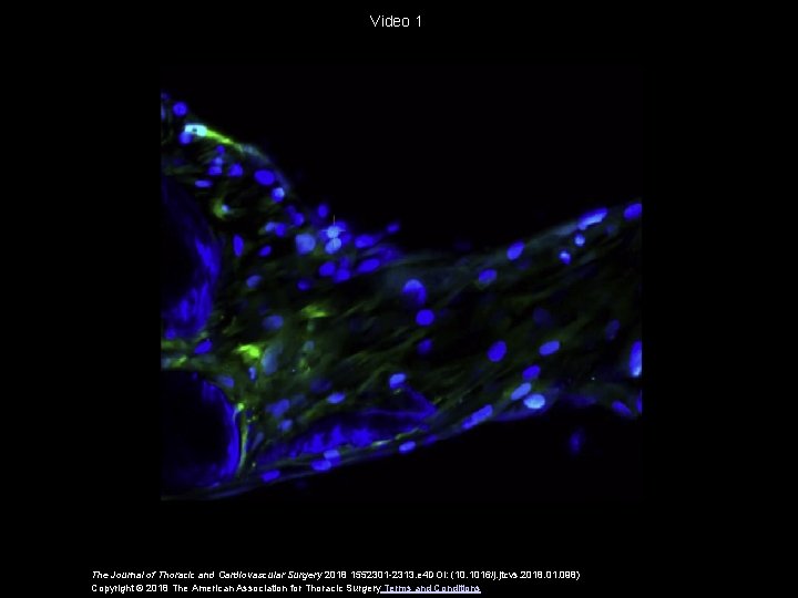 Video 1 The Journal of Thoracic and Cardiovascular Surgery 2018 1552301 -2313. e 4