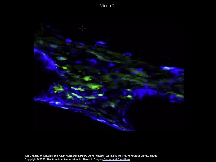 Video 2 The Journal of Thoracic and Cardiovascular Surgery 2018 1552301 -2313. e 4