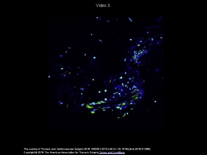Video 3 The Journal of Thoracic and Cardiovascular Surgery 2018 1552301 -2313. e 4