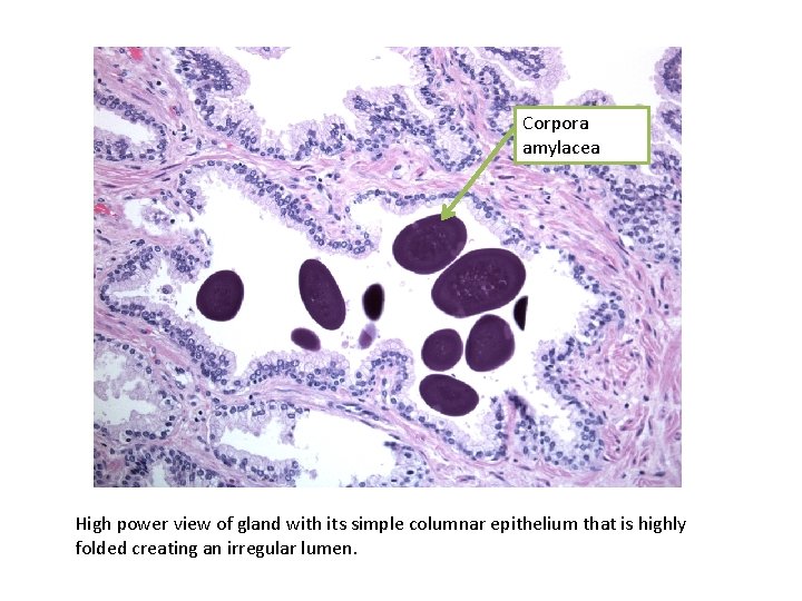 Corpora amylacea High power view of gland with its simple columnar epithelium that is