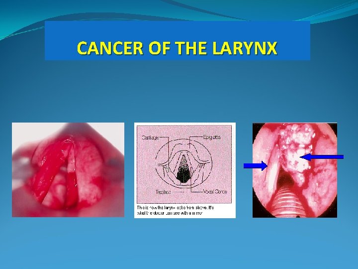CANCER OF THE LARYNX 
