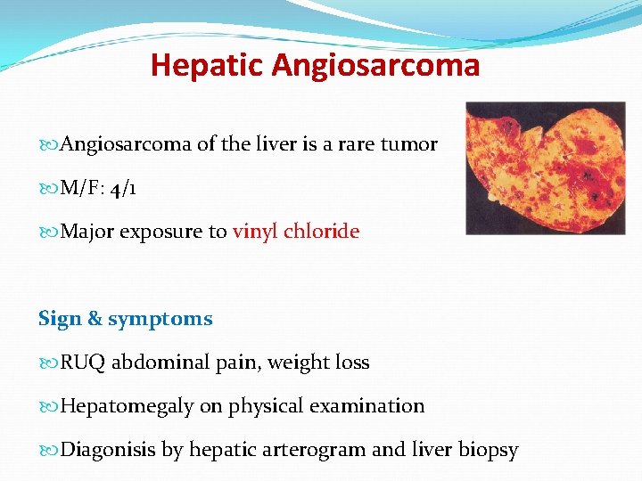 Hepatic Angiosarcoma of the liver is a rare tumor M/F: 4/1 Major exposure to